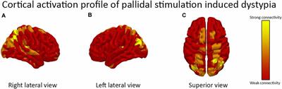 Case Report: Globus Pallidus Internus (GPi) Deep Brain Stimulation Induced Keyboard Typing Dysfunction